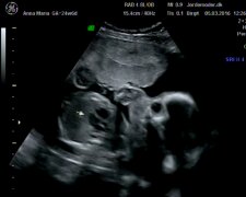 Badanie USG/ YouTube @Aneladk28