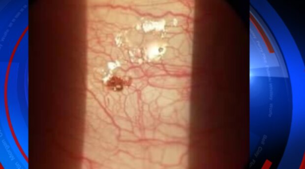 Kleszcz w oku/goodtimes.my