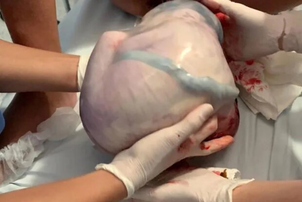 Nietypowy poród. Źródło: parenting.pl