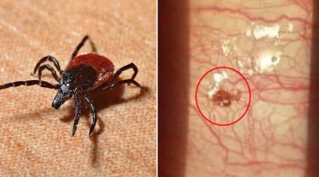 Kleszcz w oku/goodtimes.my