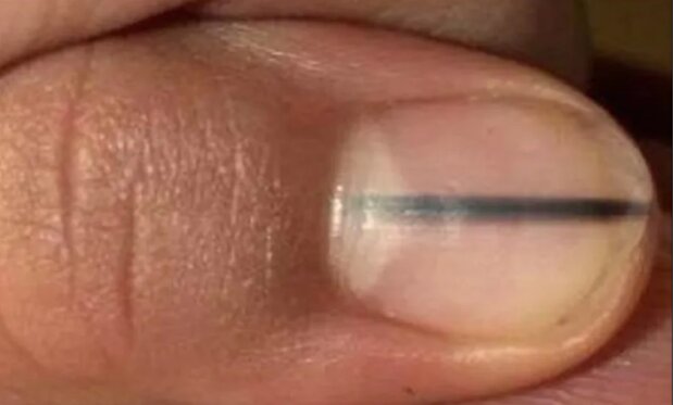 Rak paznokcia/abczdrowie.pl