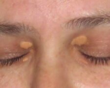 Symptom chorób serca/Youtube @Dermaworld Skin & Hair Clinics